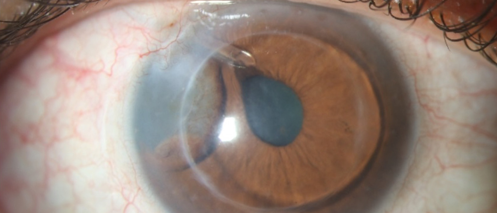 Epithelial Downgrowth