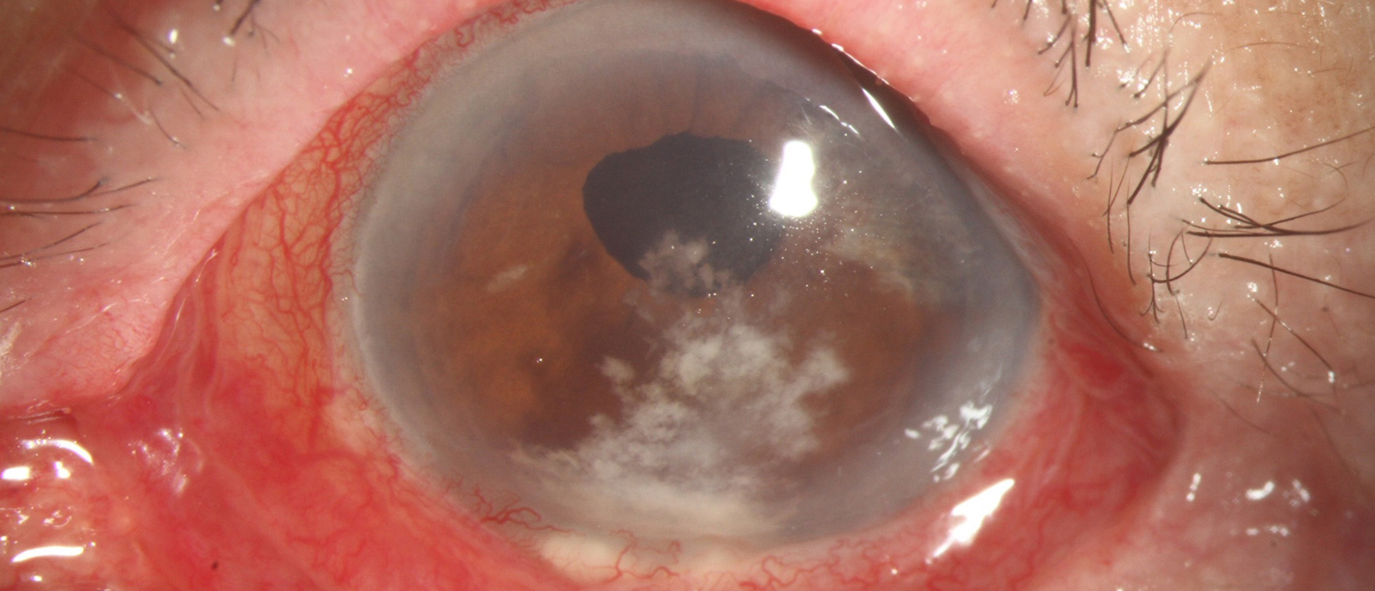 DSEK Interface Keratitis due to Candida