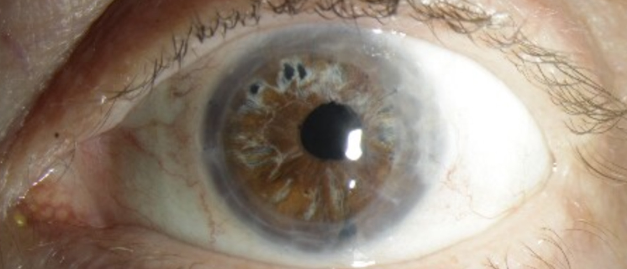 Pseudophakic Bullous Keratopathy, Corneal Edema