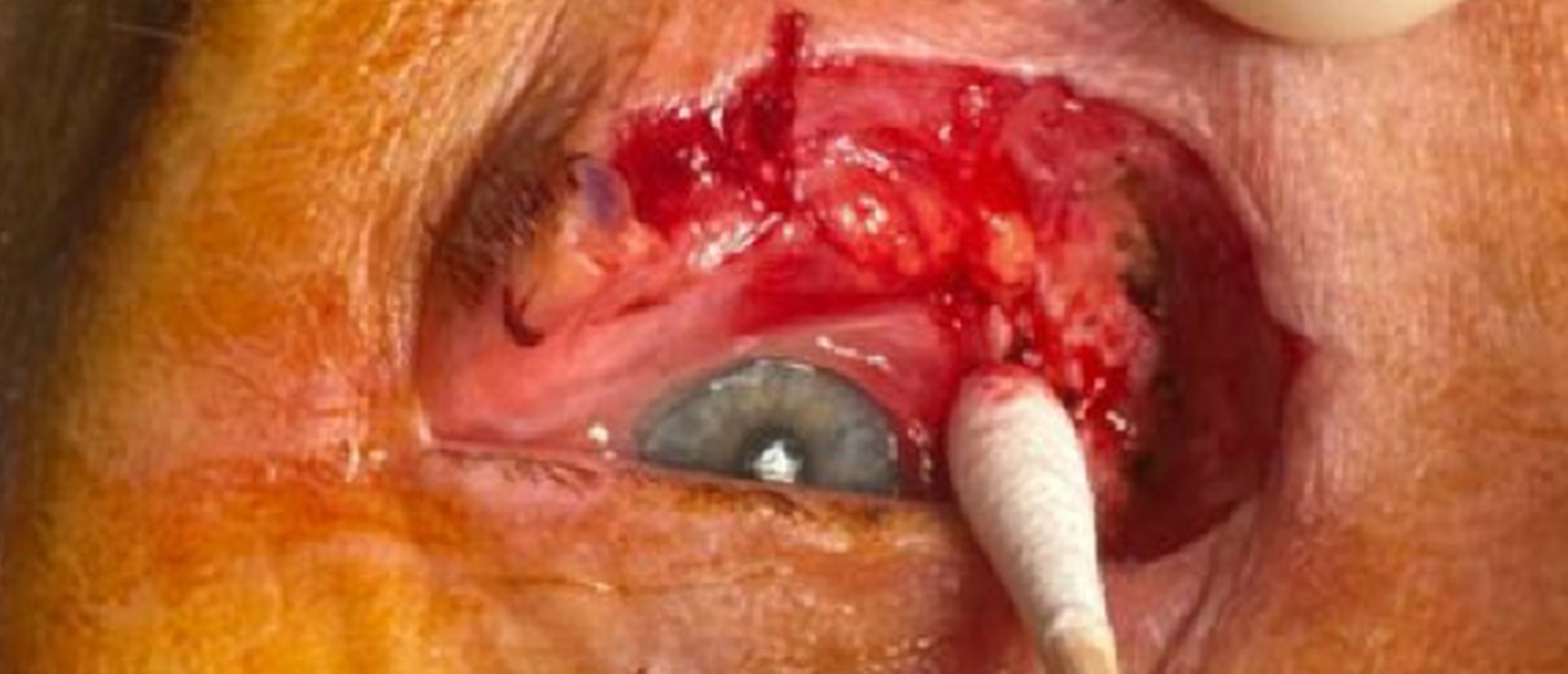 Recurrent Locally Advance Morpheaform BCC