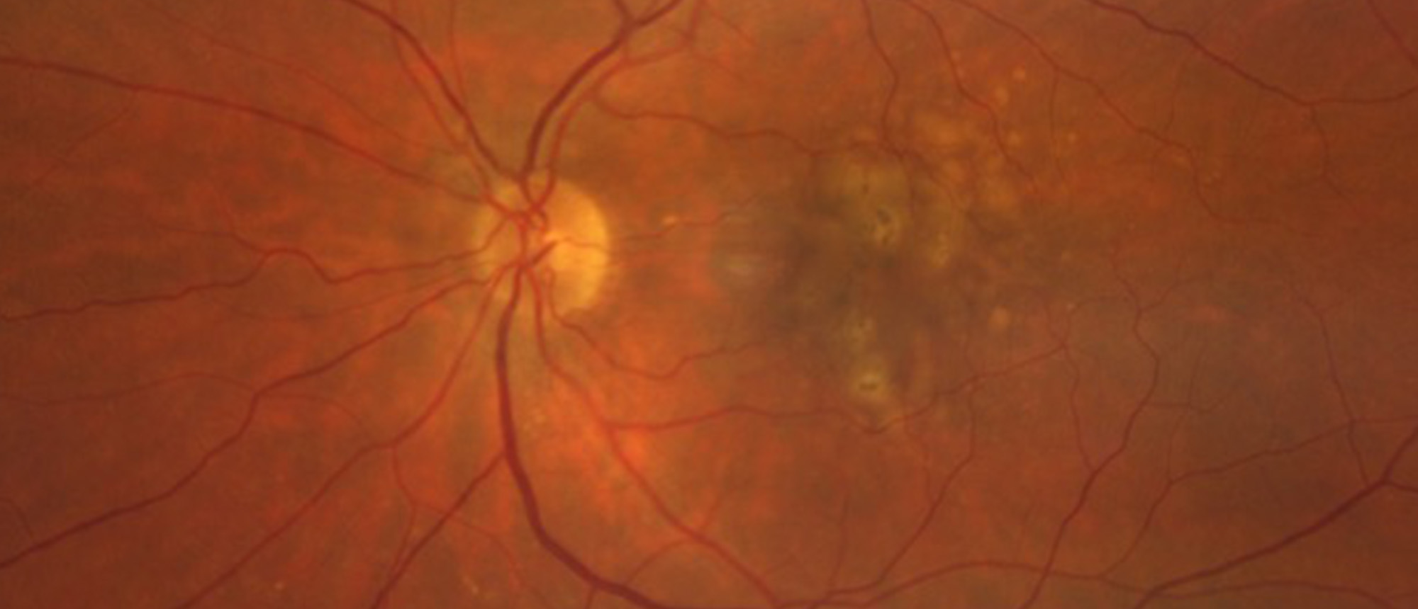 Incipient Non-Arteritic Ischemic Optic Neuropathy