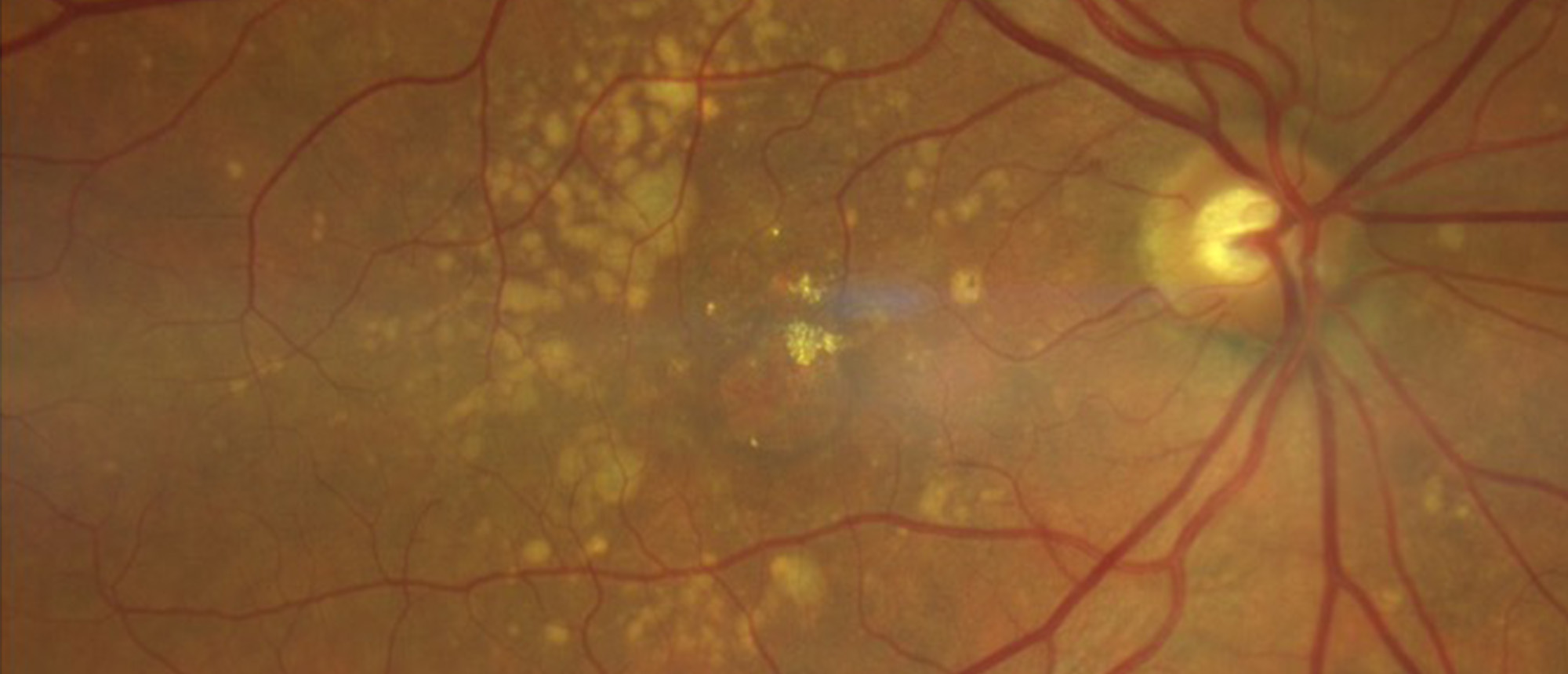 Pegcetacoplan Associated Exudation