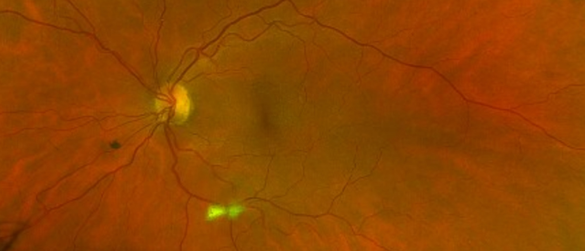 Toxoplasma Papillitis