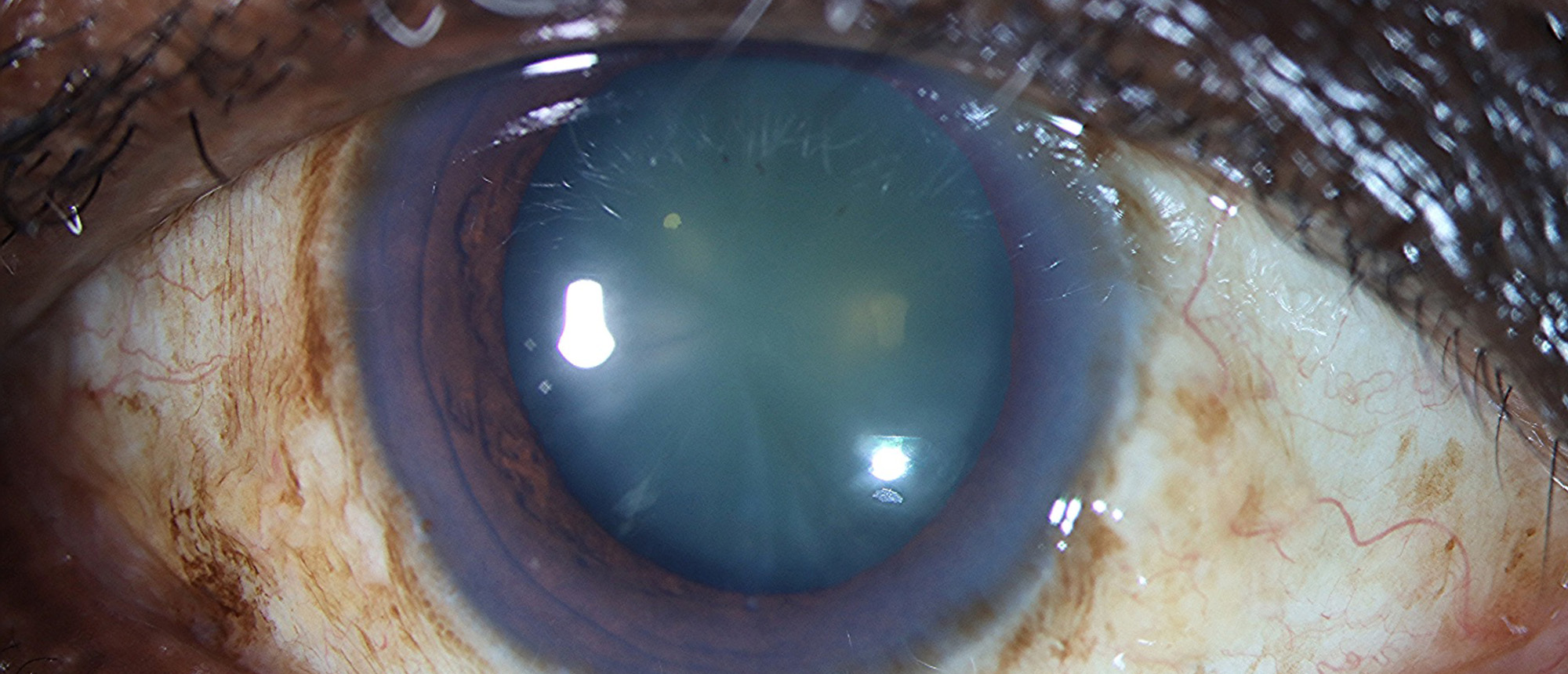 Long Anterior Zonules and Pigment Dispersion Syndrome-Variant