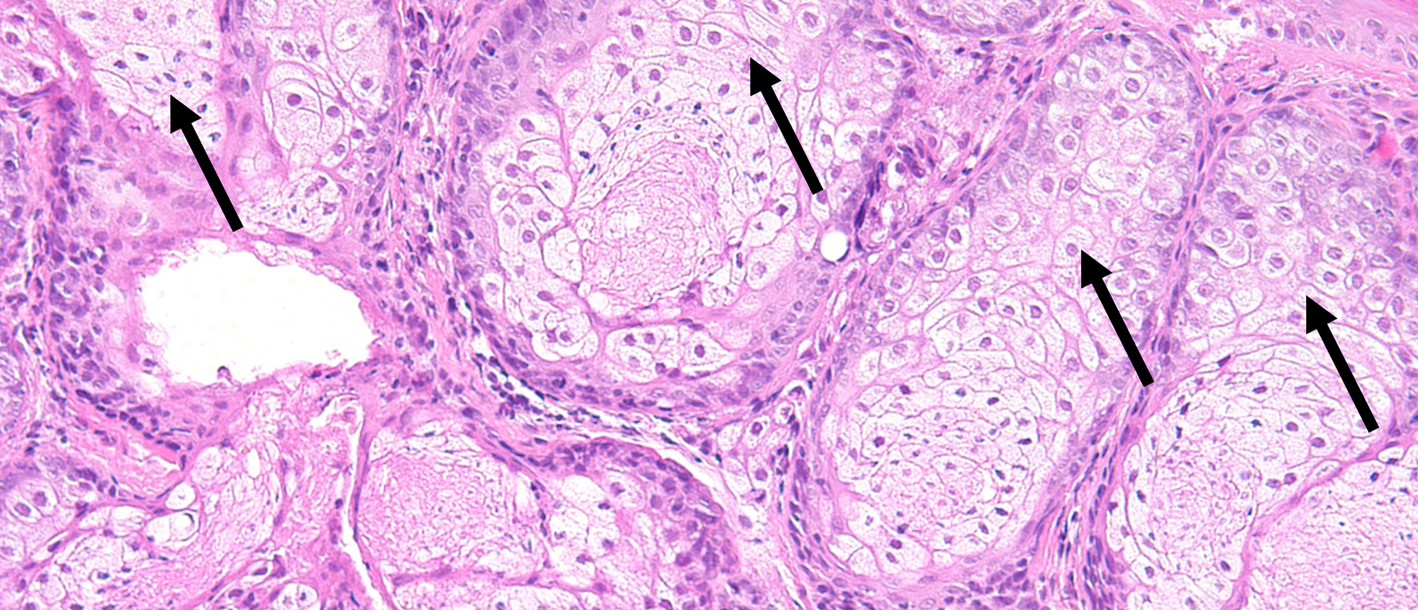 Adult-Onset Asthma with Periocular Xanthogranuloma