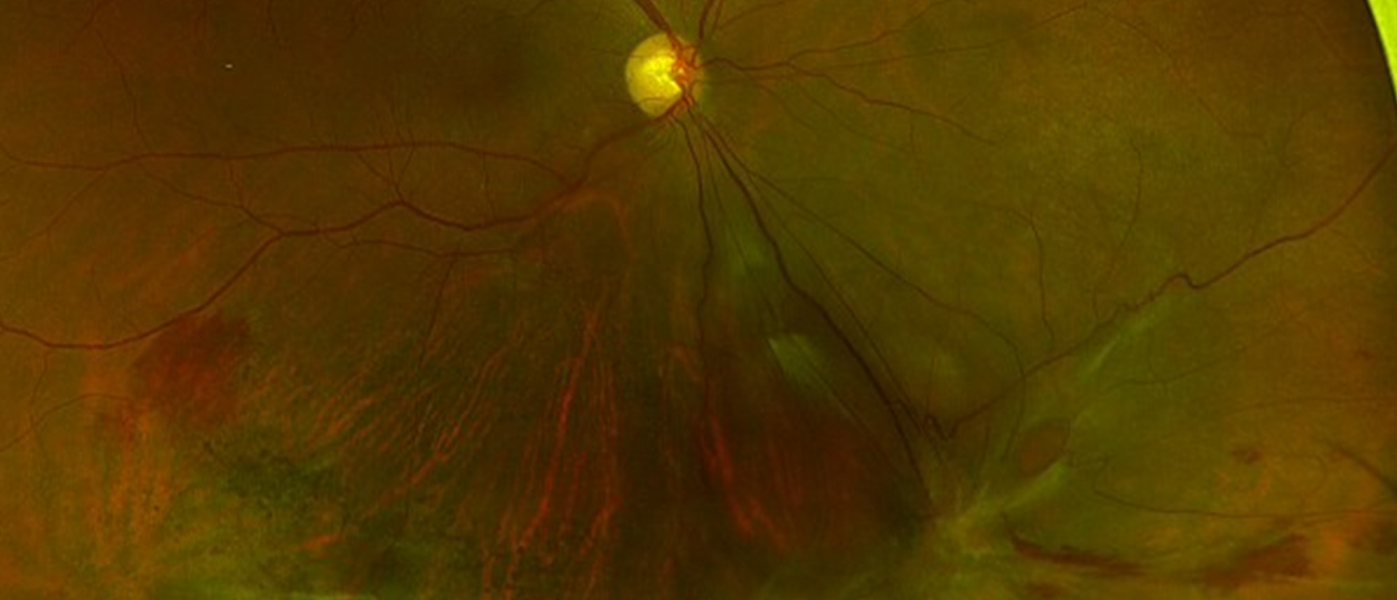 Blunt Right Eye Trauma with a Transected Inferior Rectus Muscle Resulting in Severe Right Hypertropia