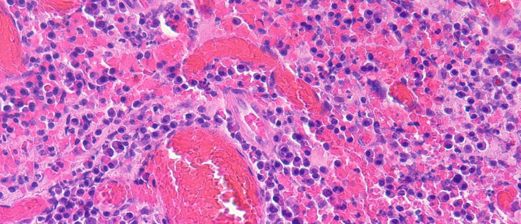 Community-Acquired Methicillin-Resistant Staphylococcus Aureus (MRSA) Caused Episcleral Mass Resembling Granuloma
