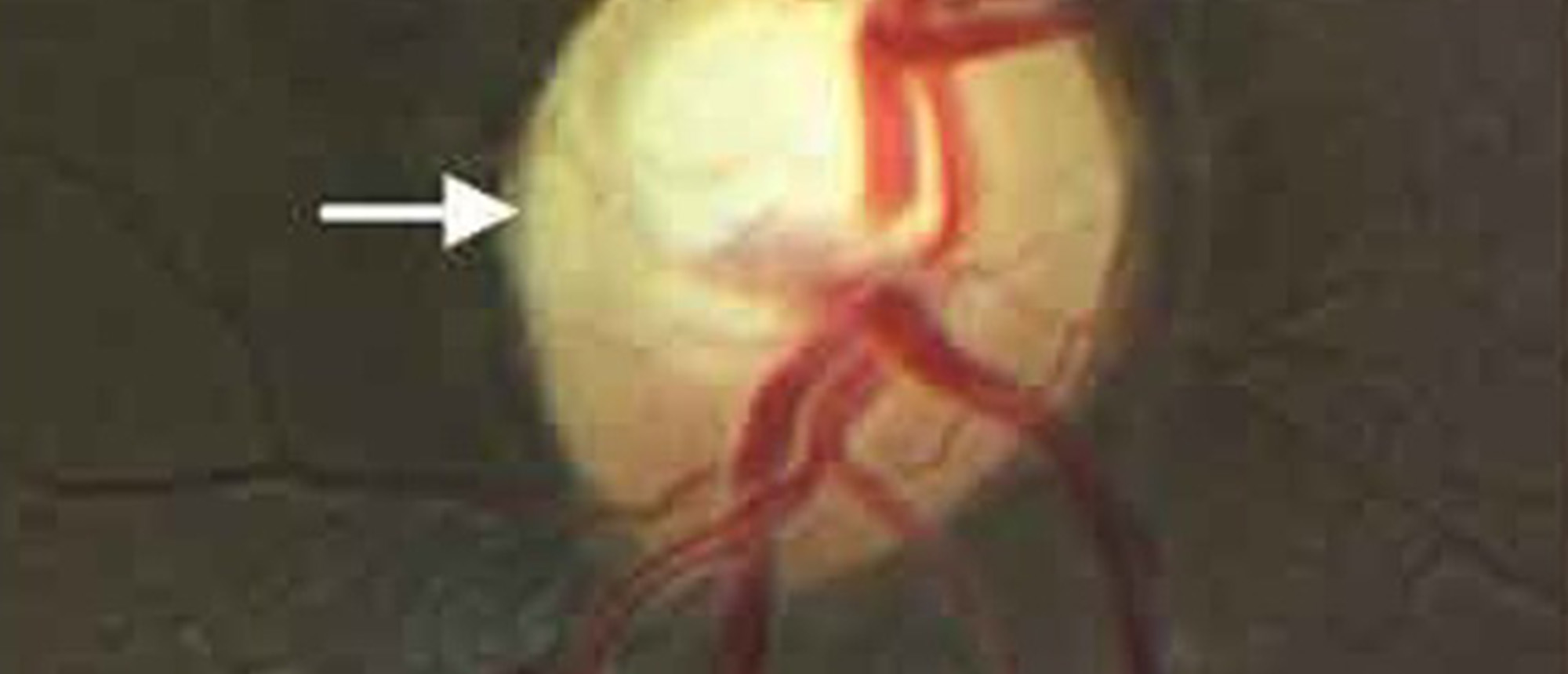 Orbital B-Cell Lymphoma in the Setting of Primary Open Angle Glaucoma