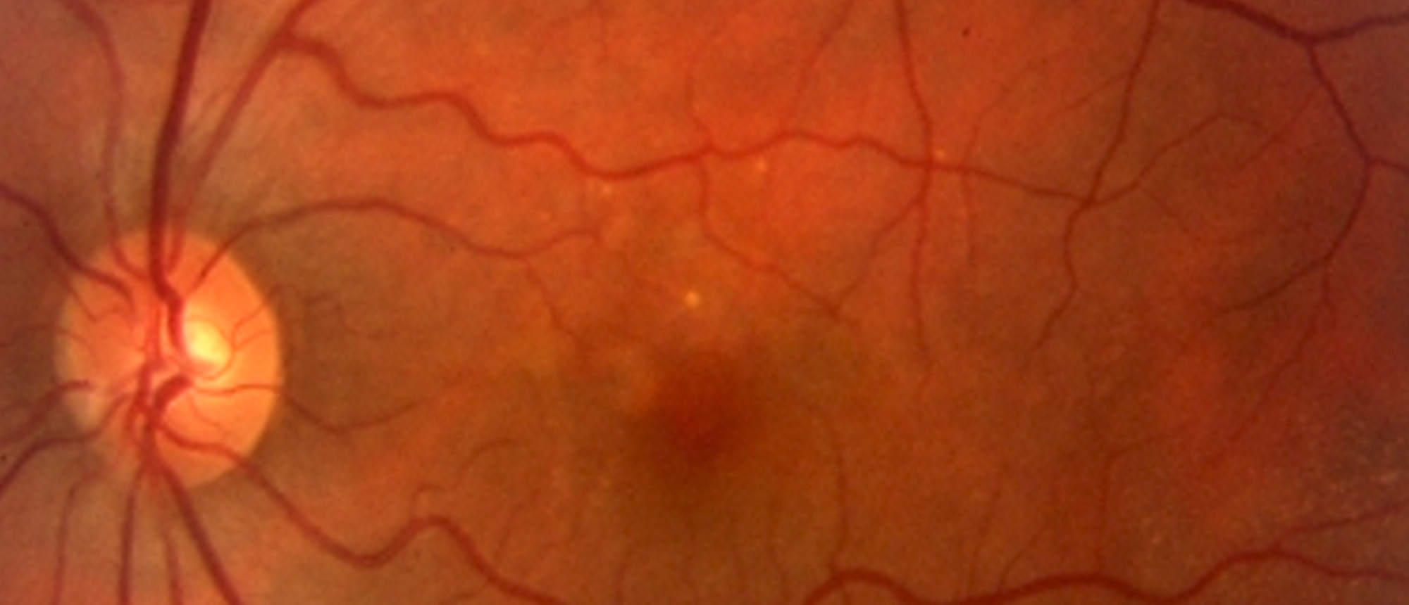 Chronic Central Serous Chorioretinopathy in Both Eyes Evolving Into Polypoidal Choroidal Vasculopathy in the Right Eye
