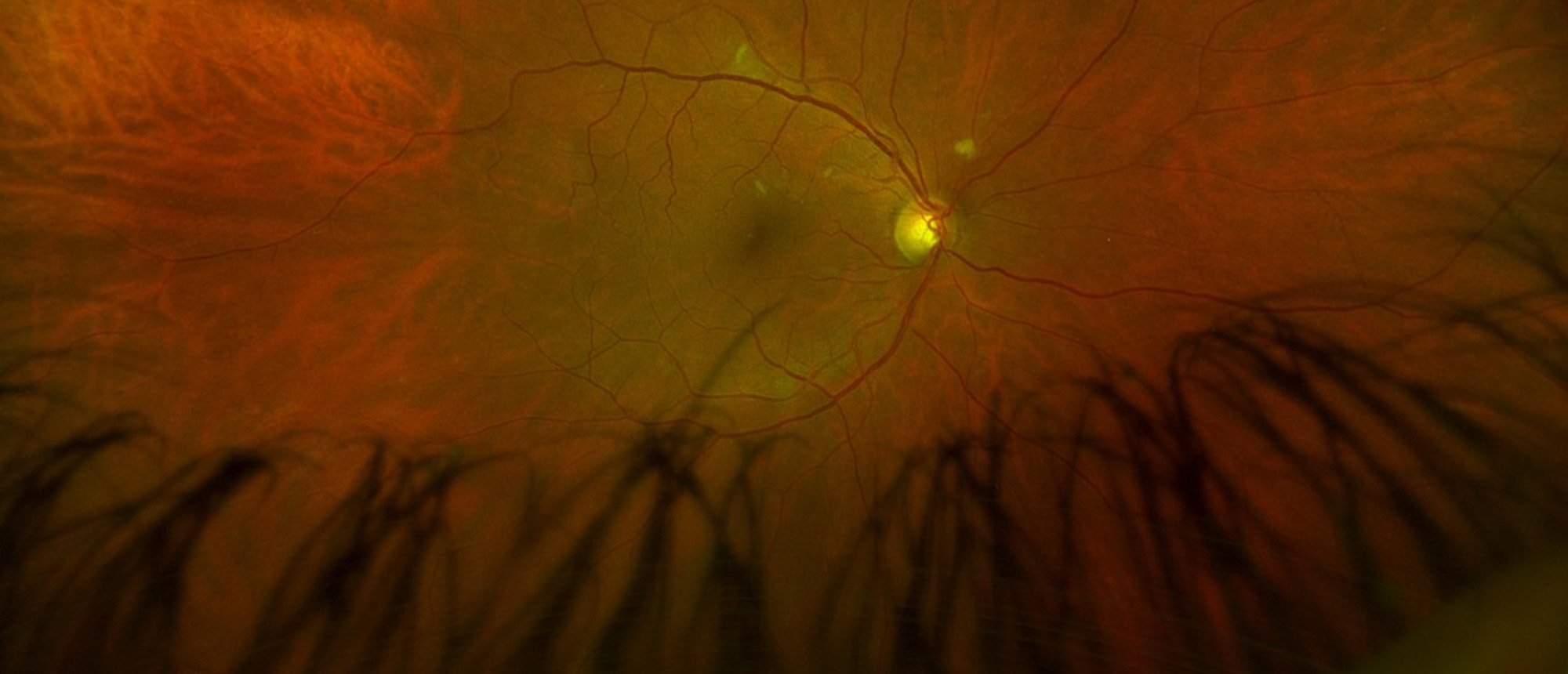 Endogenous Candida Endophthalmitis