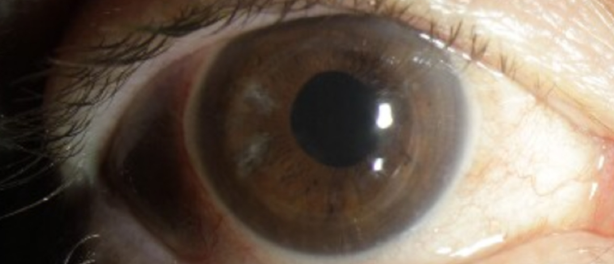 Pseudophakic Bullous Keratopathy