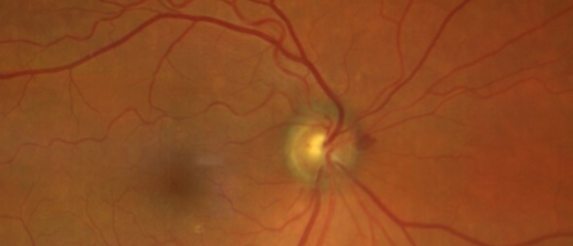 Infiltrative Optic Neuropathy Secondary to Pleomorphic Mantle Cell Lymphoma