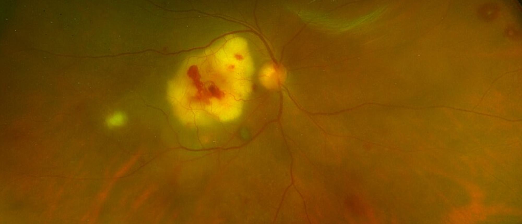 Bilateral Endogenous Aspergillus Endophthalmitis