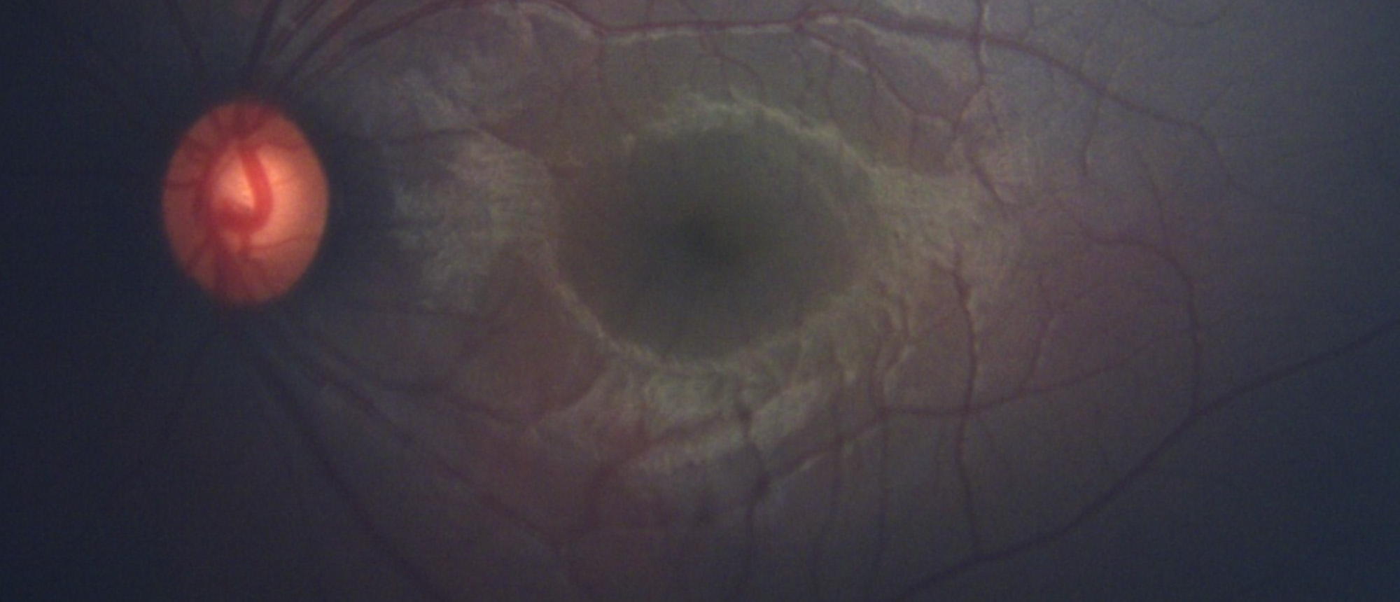 Sturge Weber Syndrome