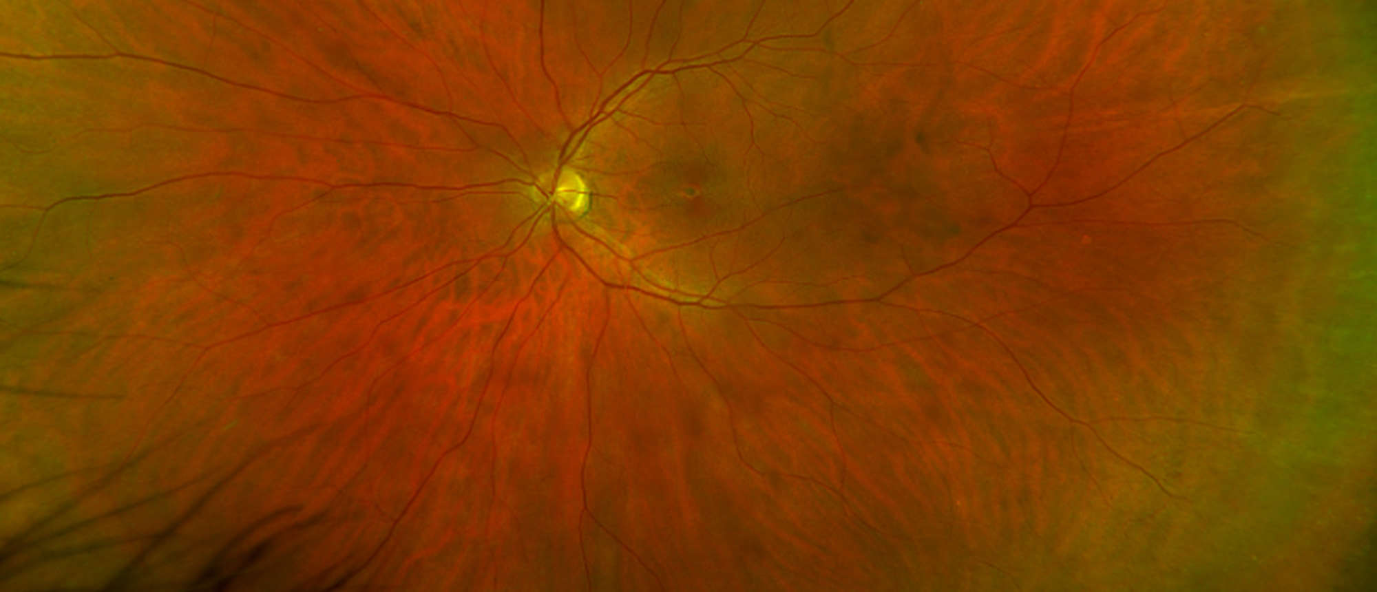 PRPH2-Associated Pattern Dystrophy