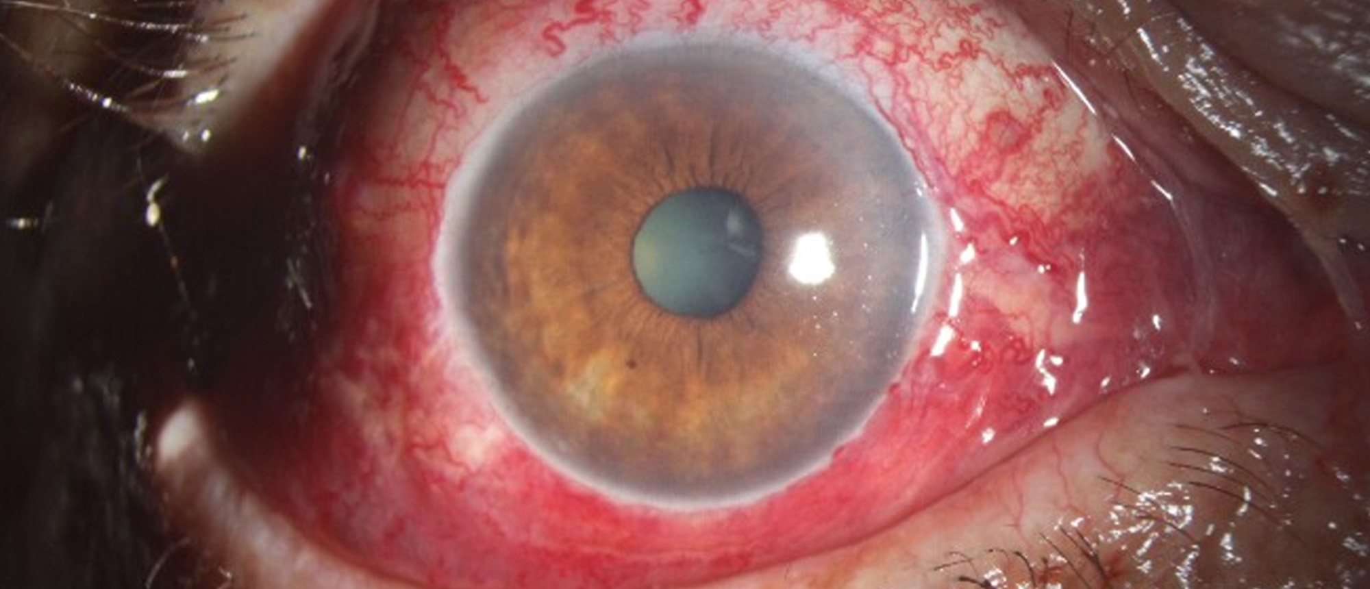 Superior Ophthalmic Vein Thrombosis with likely Cavernous Sinus Thrombosis