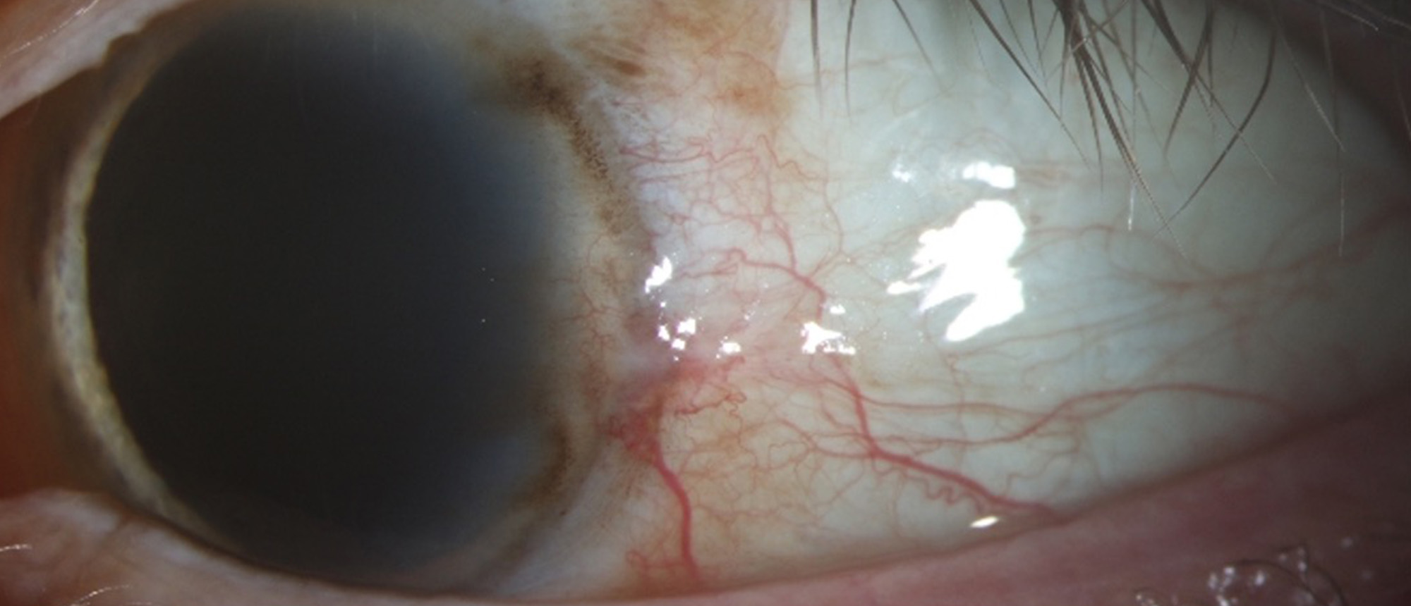 Conjunctival Melanoma Treated with Systemic Checkpoint Inhibitors