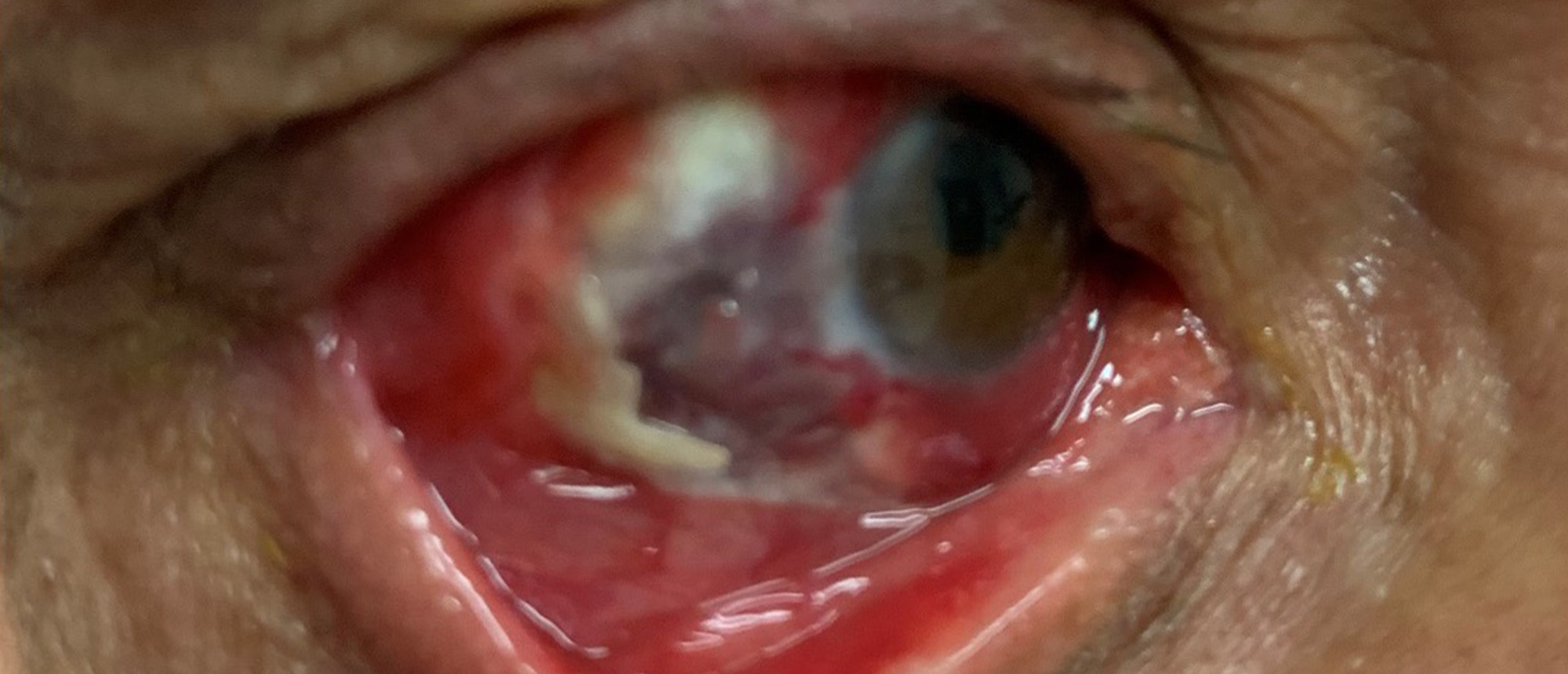 Infectious Necrotizing Scleritis