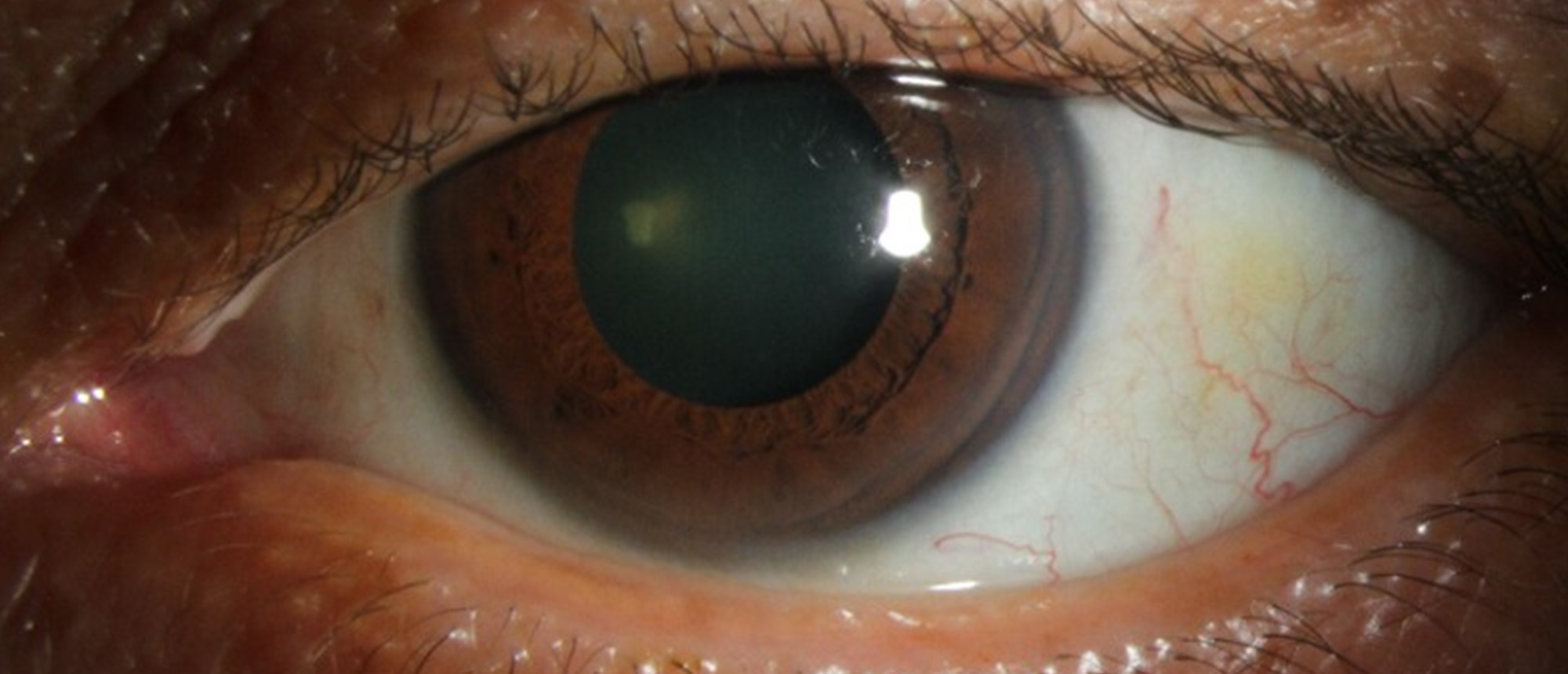 Primary Localized Conjunctival Amyloidosis