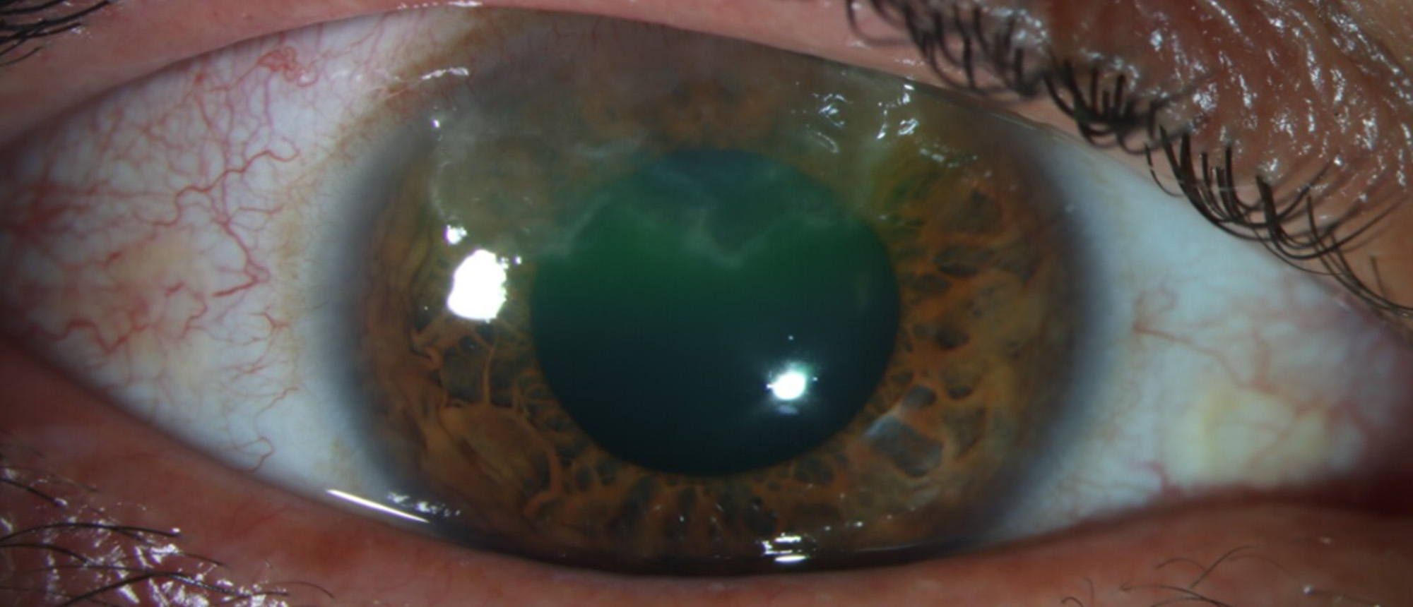 Nocardia Bacterial Keratitis