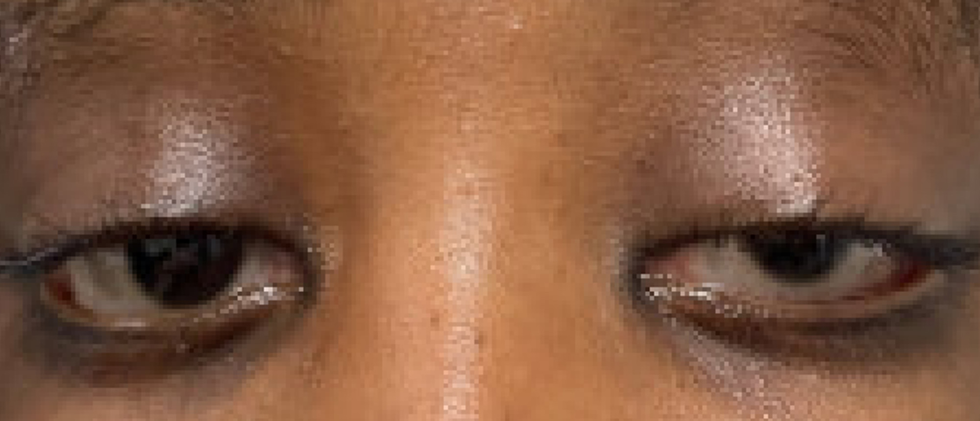 Kabuki Syndrome Associated Euryblepharon and Ptosis Repair with Post Operative Hematoma