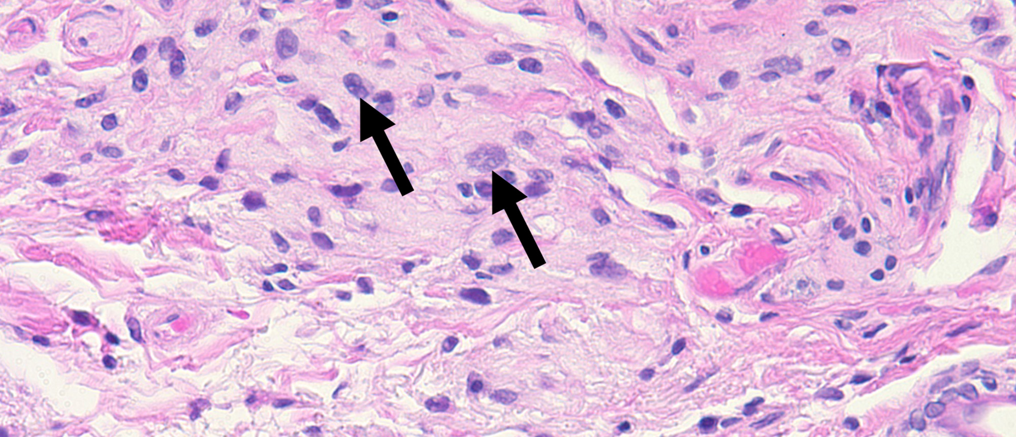 Invasive Cutaneous Melanoma of the Eyelid