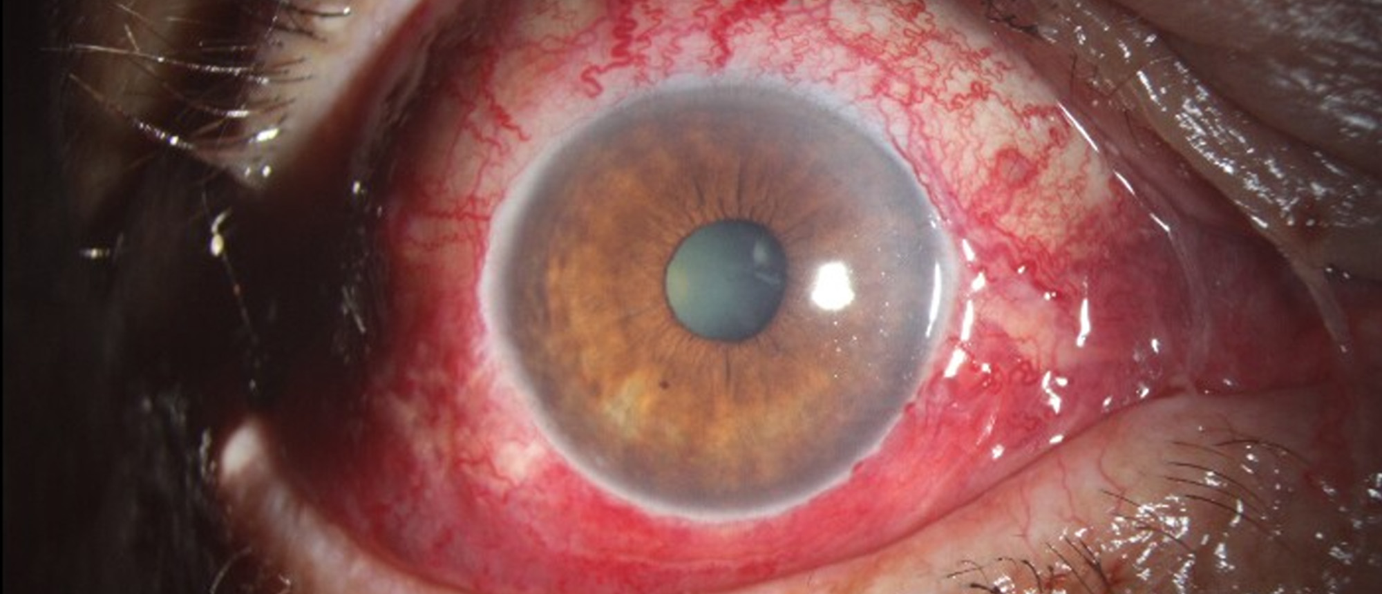Fulminant Superior Ophthalmic Vein Thrombosis with likely Cavernous Sinus Thrombosis