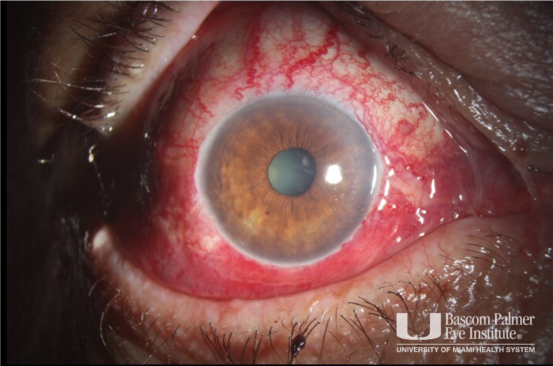 Fulminant Superior Ophthalmic Vein Thrombosis with likely Cavernous Sinus Thrombosis