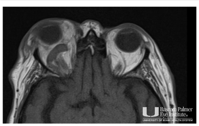 Fulminant Superior Ophthalmic Vein Thrombosis with likely Cavernous Sinus Thrombosis