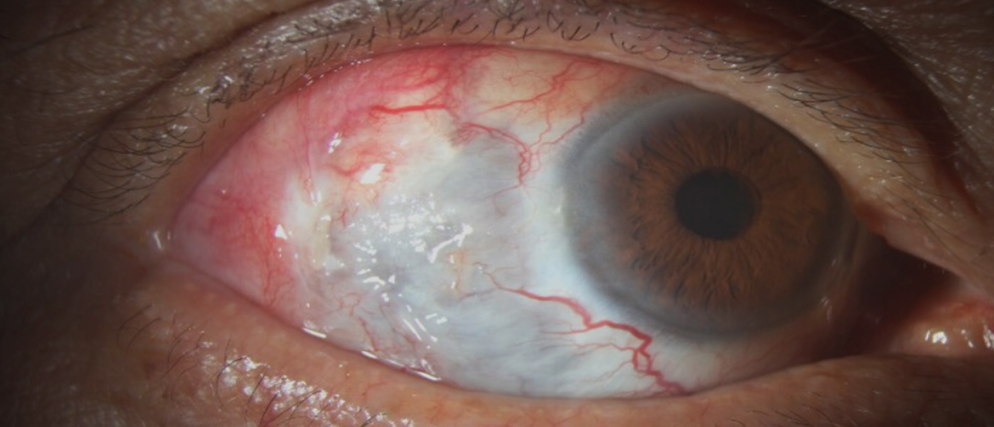Pseudomonas Necrotizing Scleritis