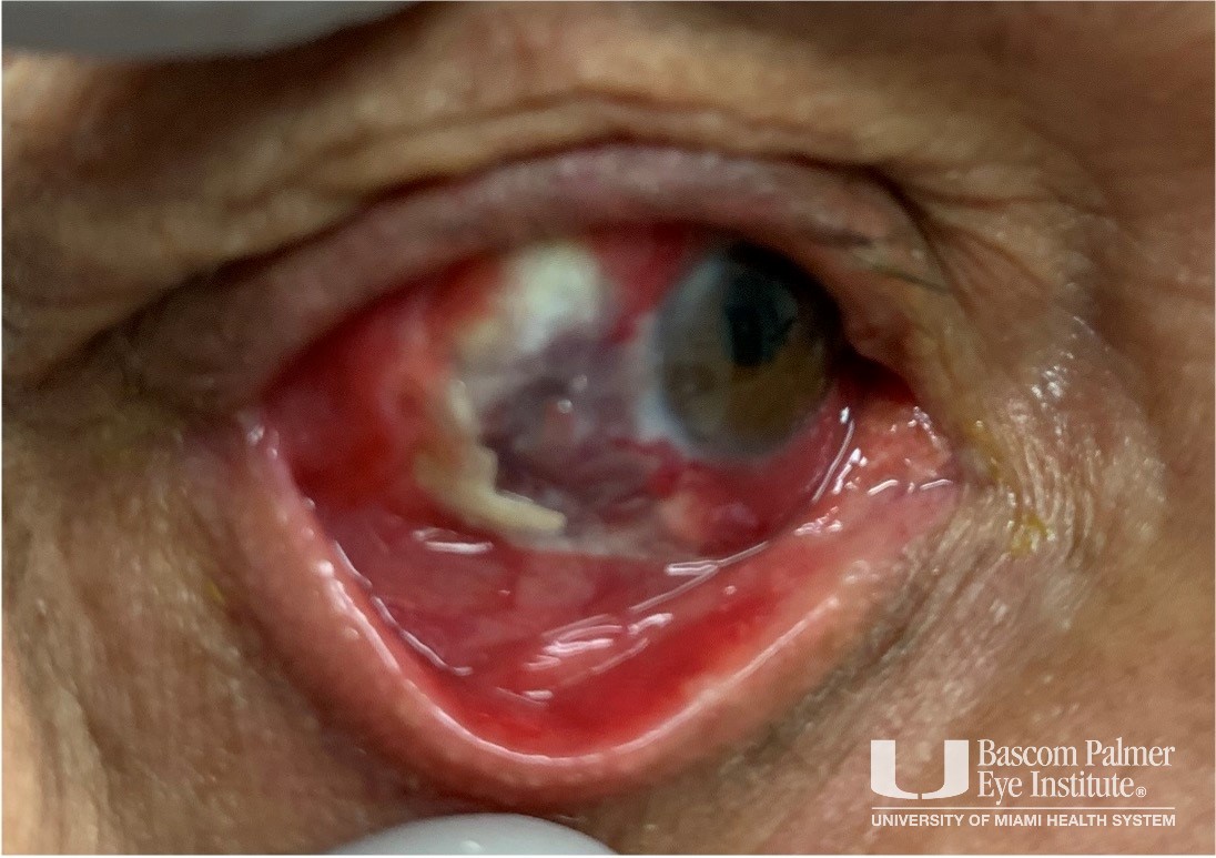 Pseudomonas Necrotizing Scleritis