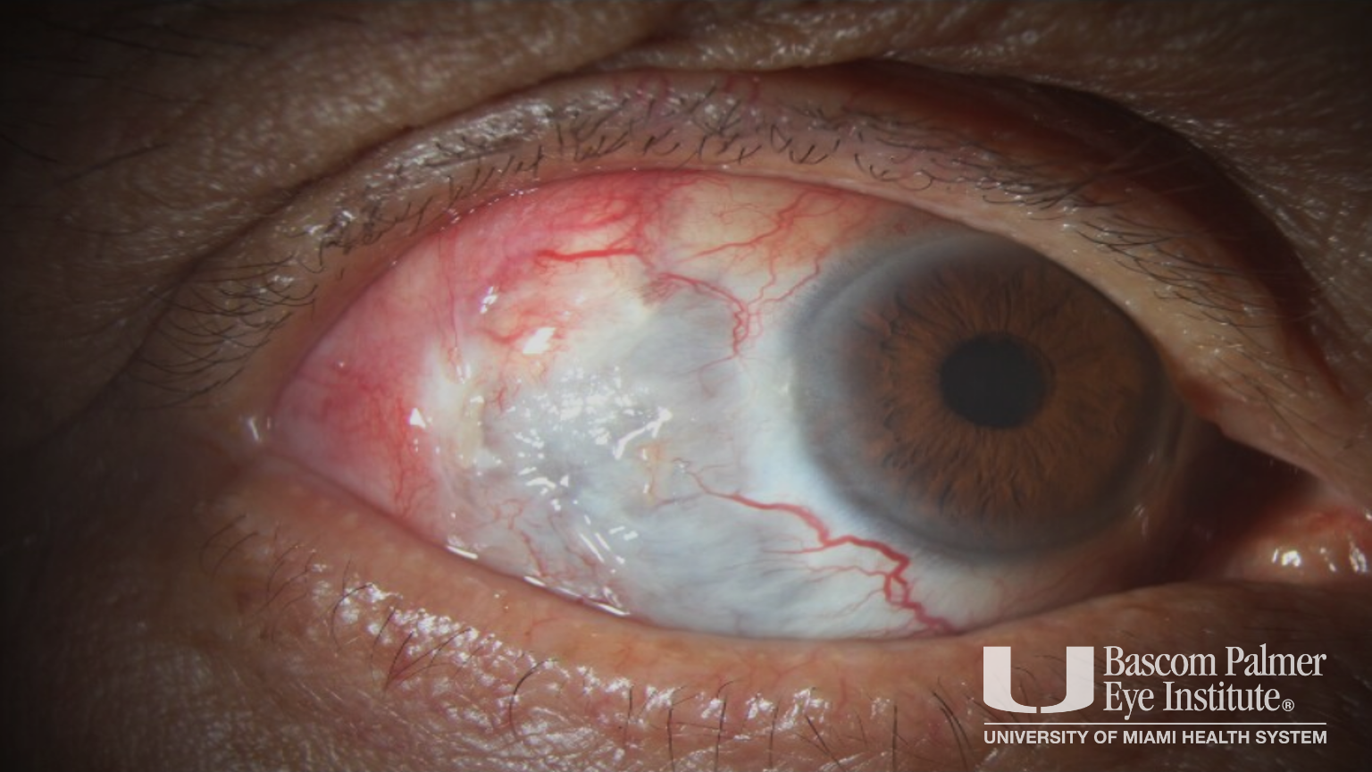 Pseudomonas Necrotizing Scleritis