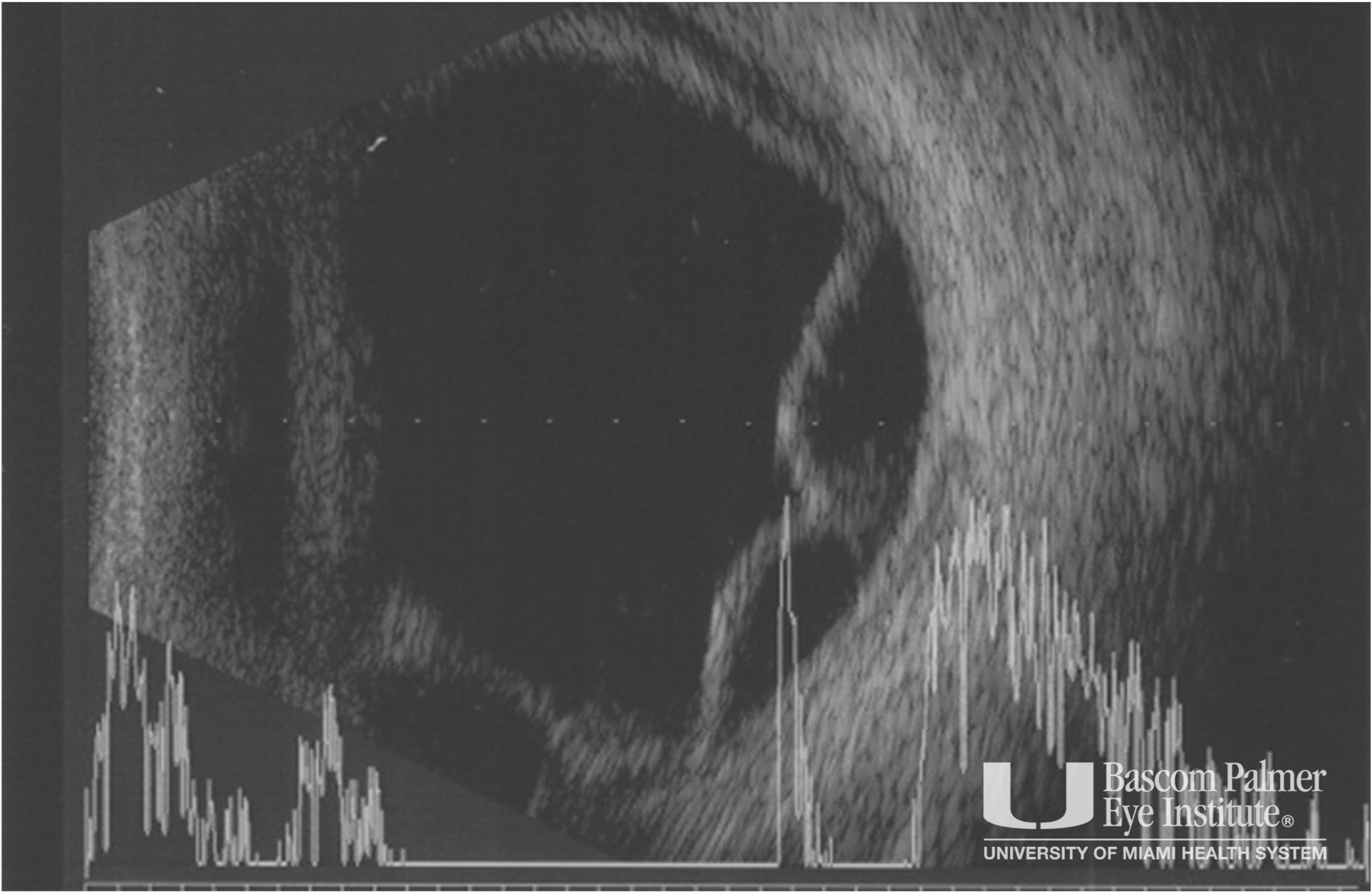 Pseudomonas Necrotizing Scleritis