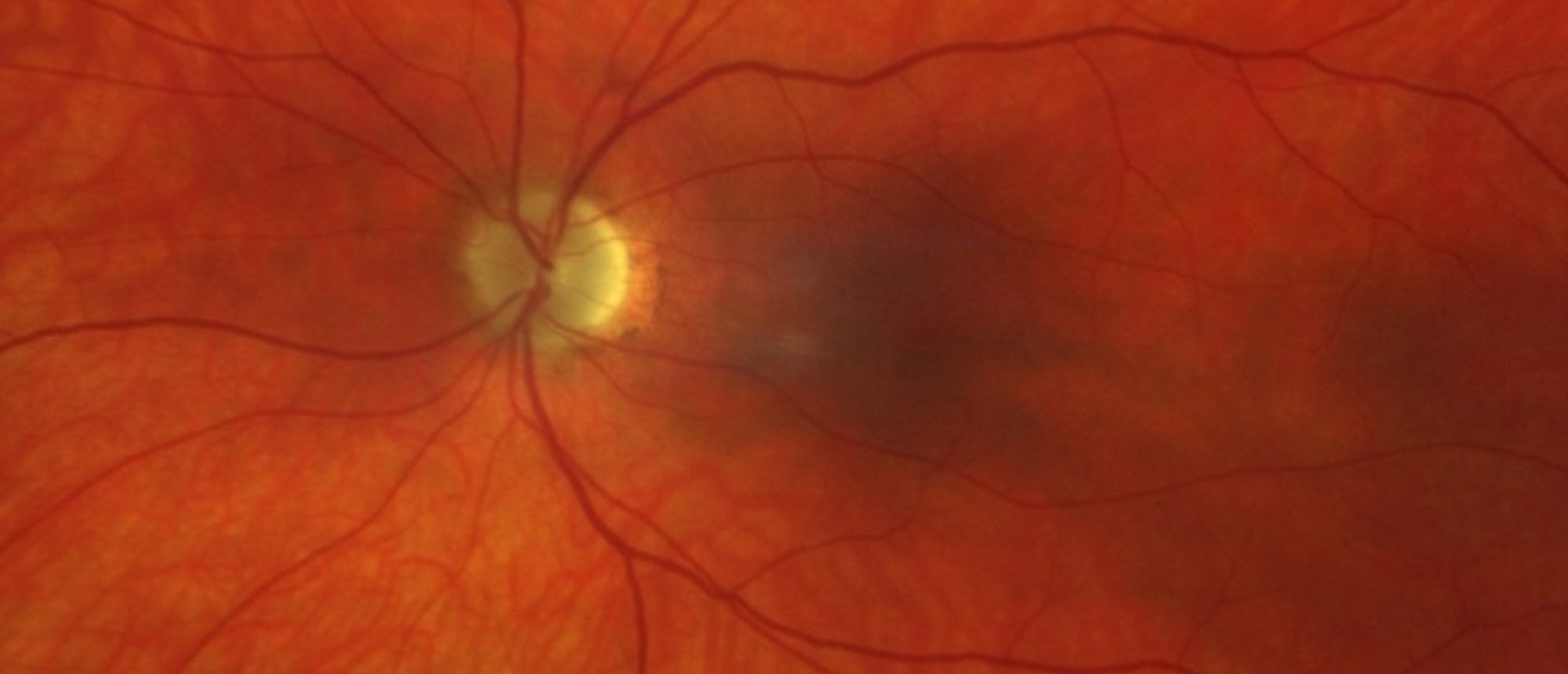 Myelin Oligodendrocyte Glycoprotein Antibody Disease