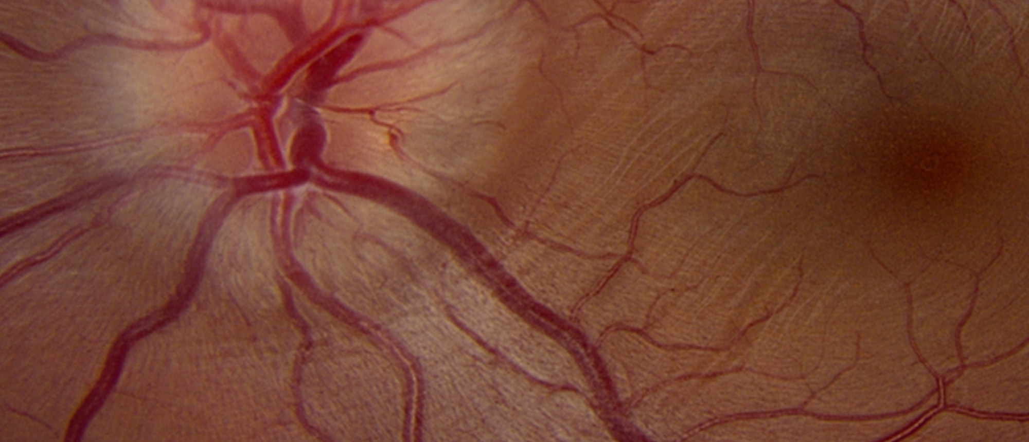 Bilateral Sturge Weber Syndrome TEST