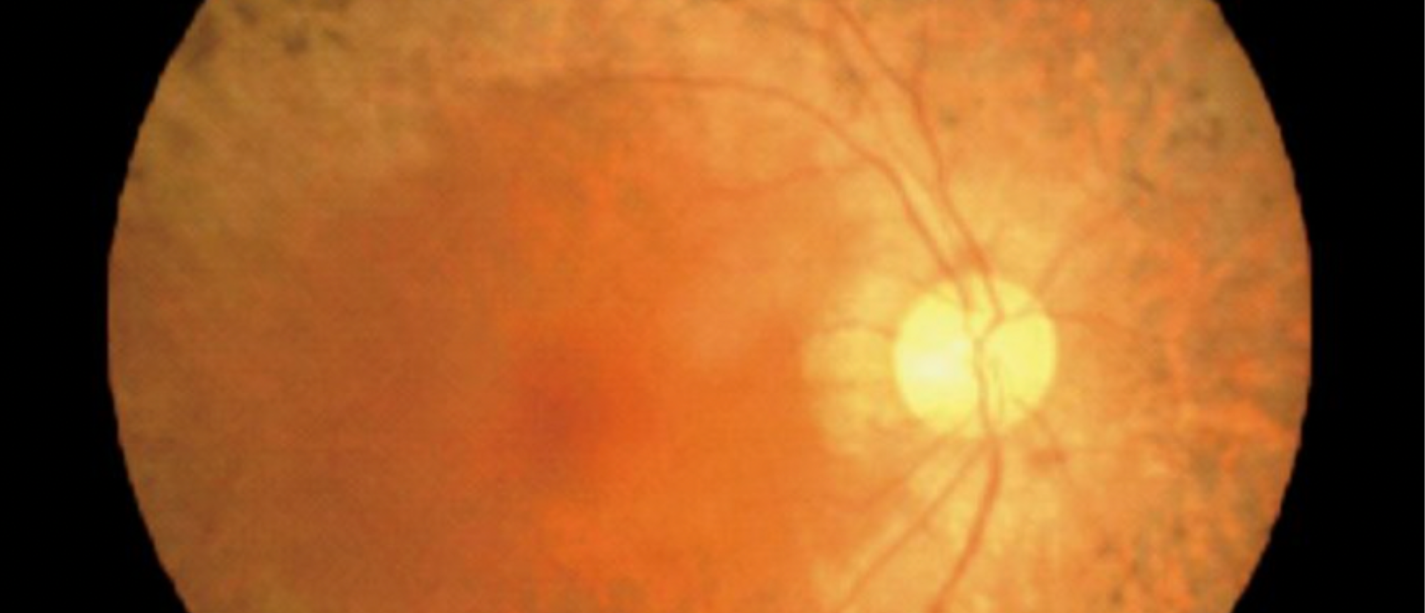 PDE6-Associated Retinitis Pigmentosa