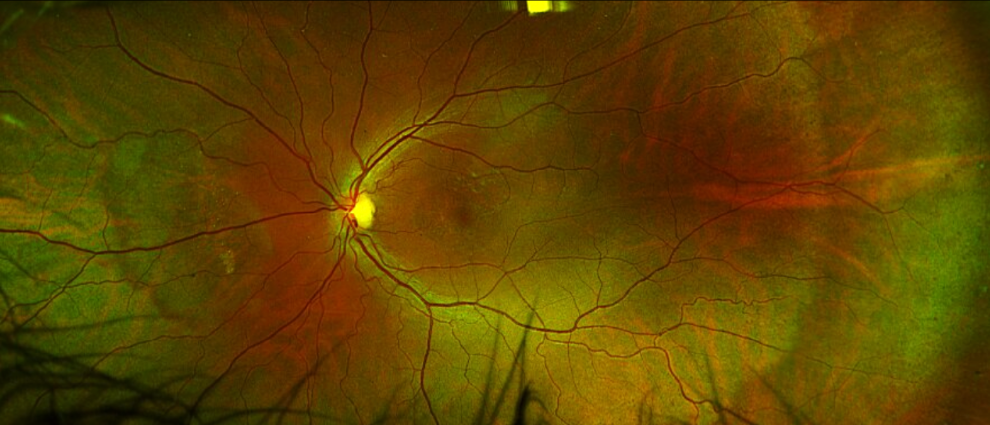 Autosomal Dominant Cone-Rod Dystrophy Caused by a Mutation in the Cone-Rod Homeobox (CRX) Gene