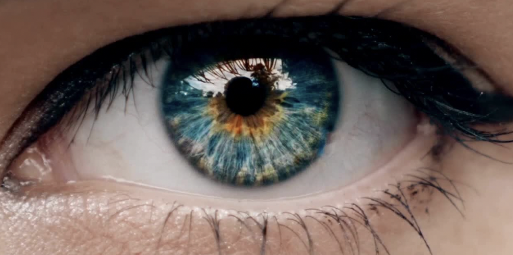 Bilateral Inferior Rectus Muscle Aplasia, Severe Hypertropia, Deprivation Amblyopia