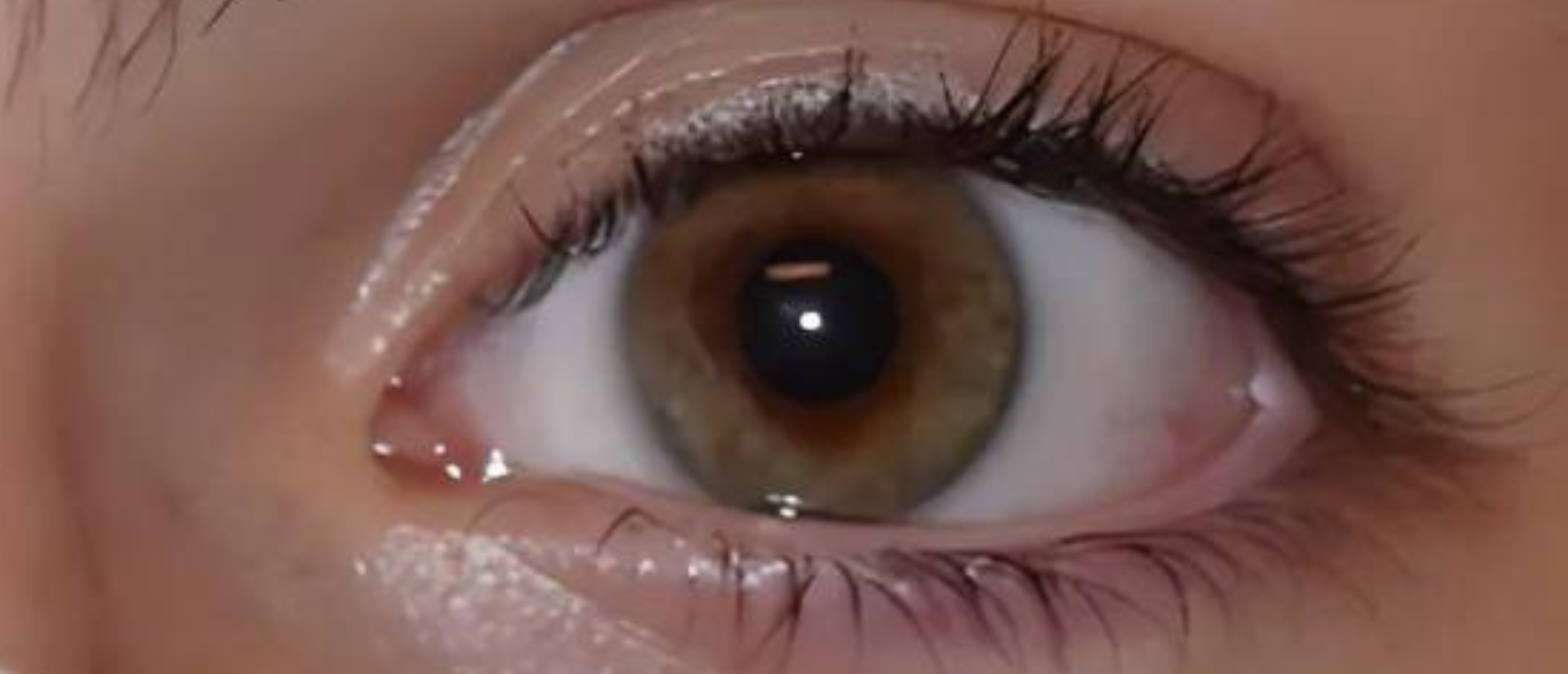 Recurrent Benign Sixth Nerve Palsy 