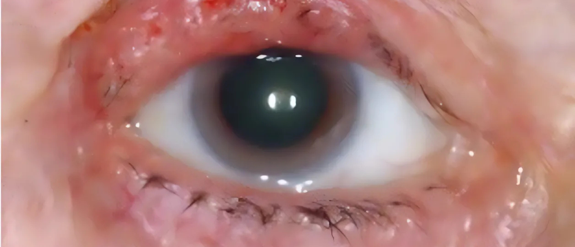 Sebaceous Cell Carcinoma 