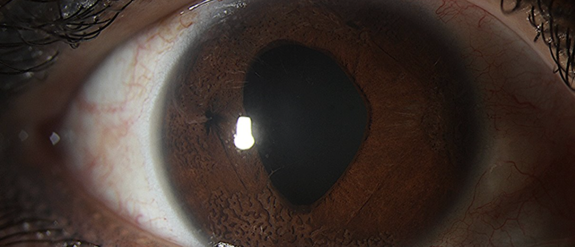 ICE Syndrome with Secondary Angle Closure Glaucoma