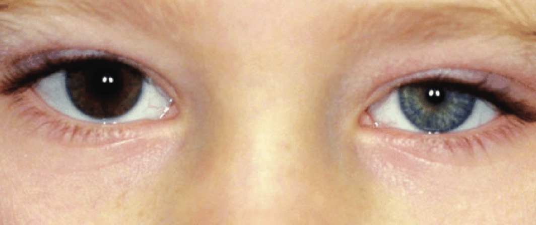 Uveal Melanoma Arising in Ocular Melanocytosis