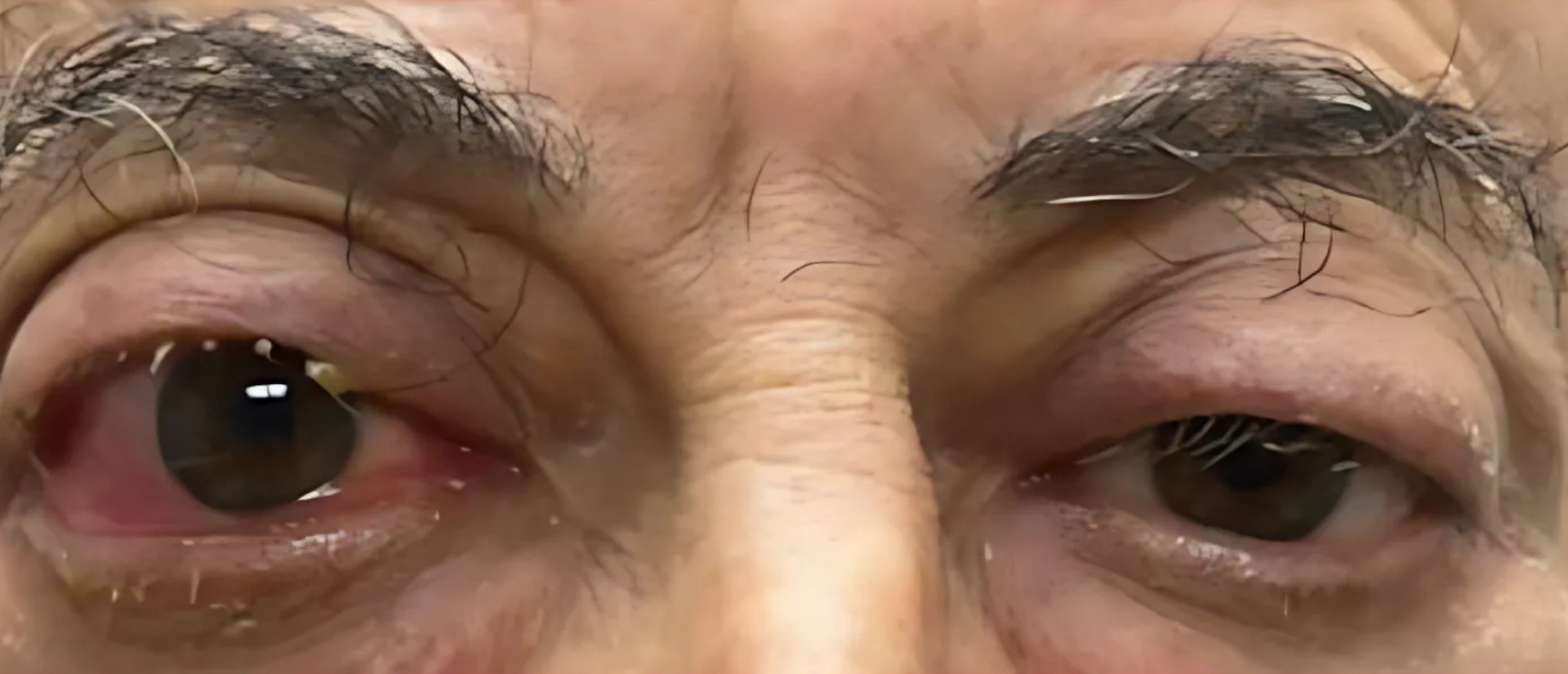 Active Thyroid Eye Disease with Pretibial Myxedema
