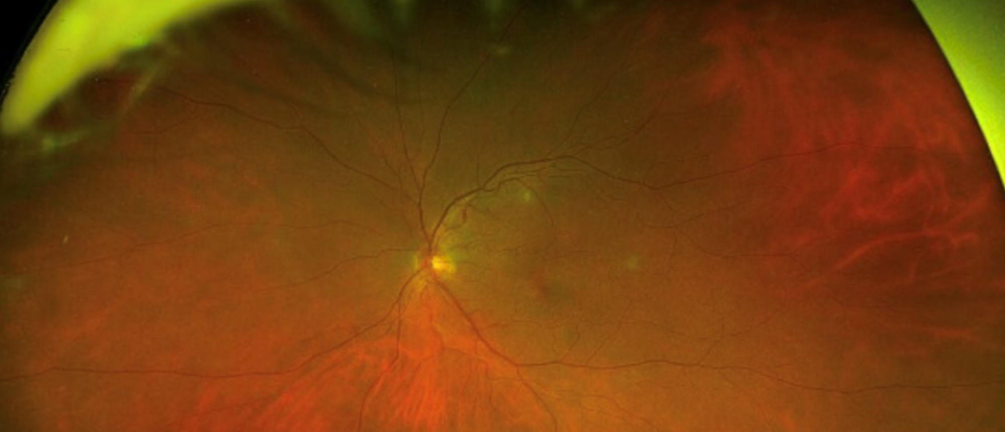 Endogenous Candida Endophthalmitis 