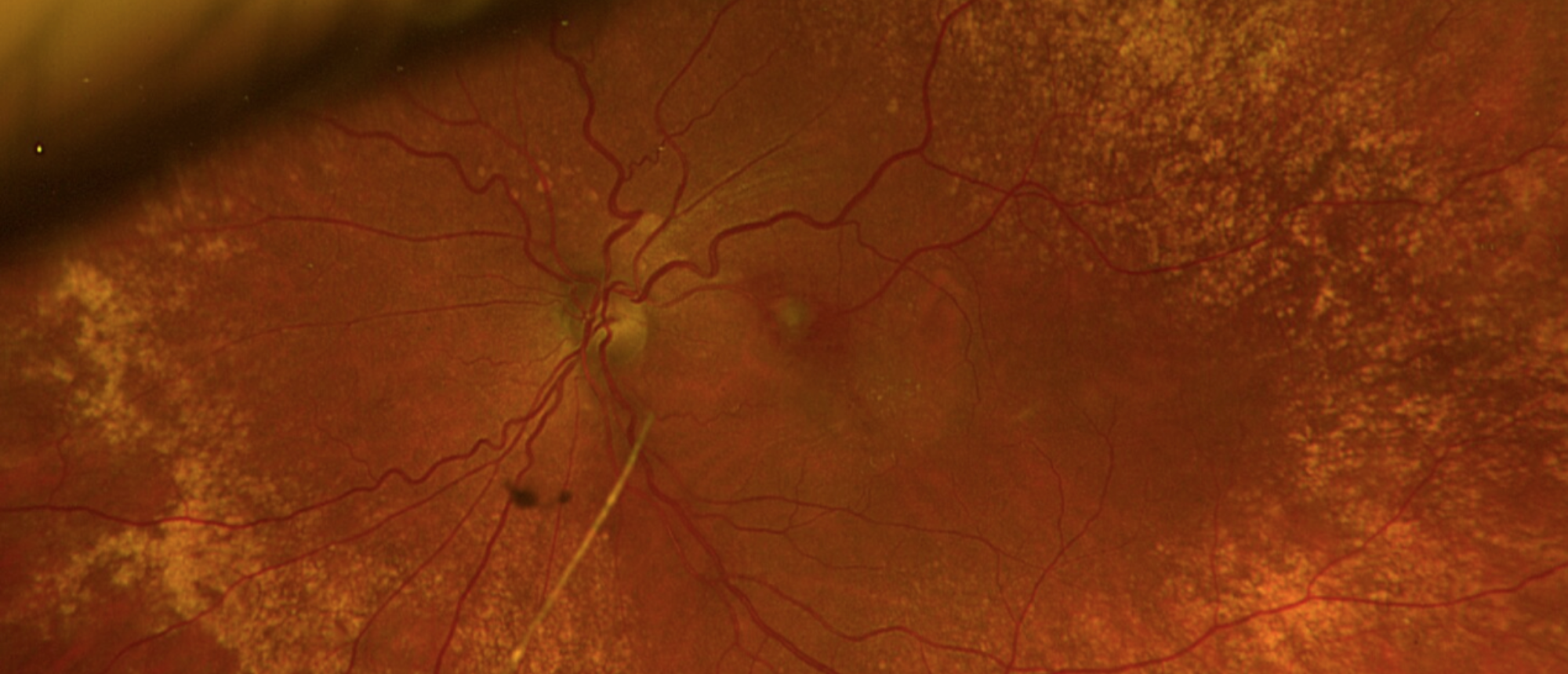 Retinal Artery Macroaneurysm