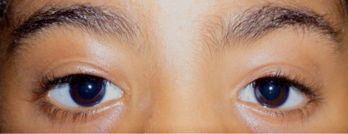 Blepharophimosis Syndrome 