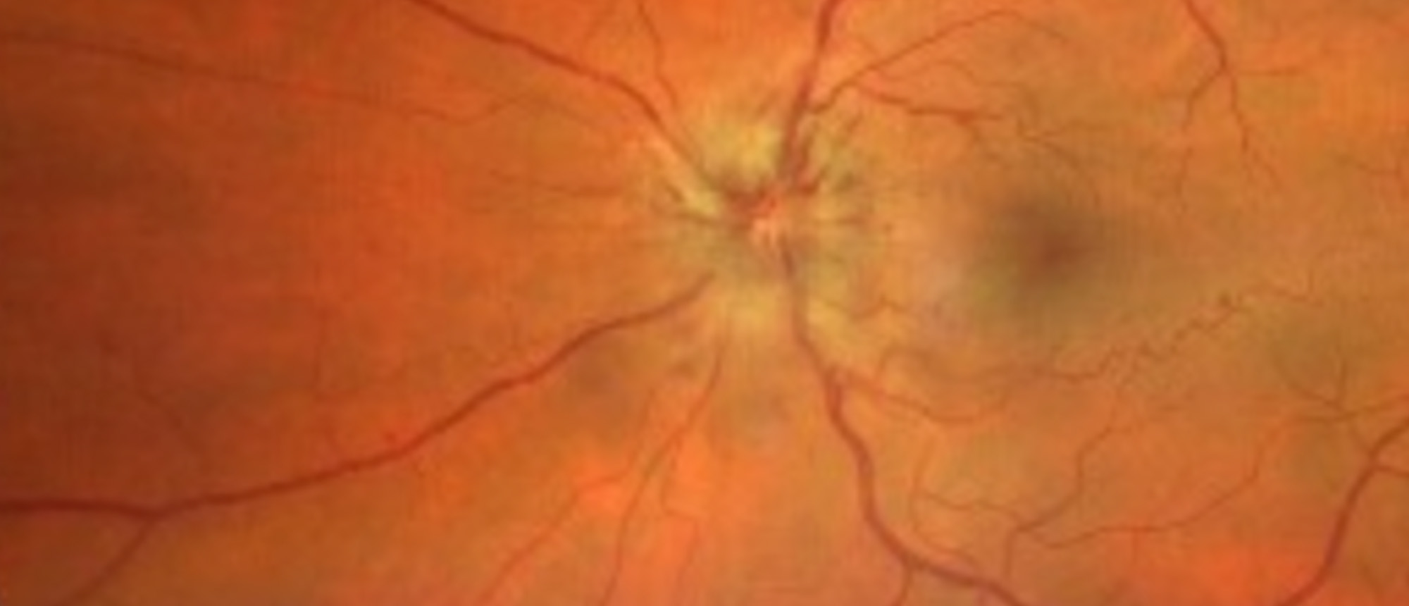 Lymphoma Infiltrative Optic Neuroapthy