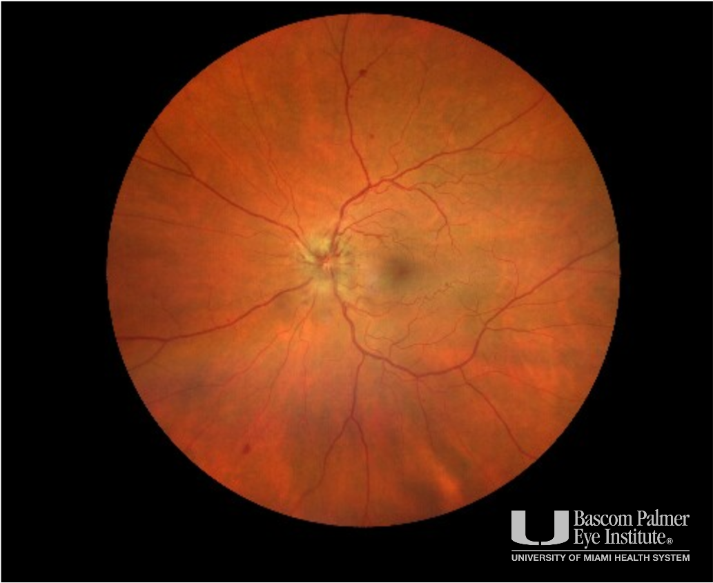 Lymphoma Infiltrative Optic Neuroapthy