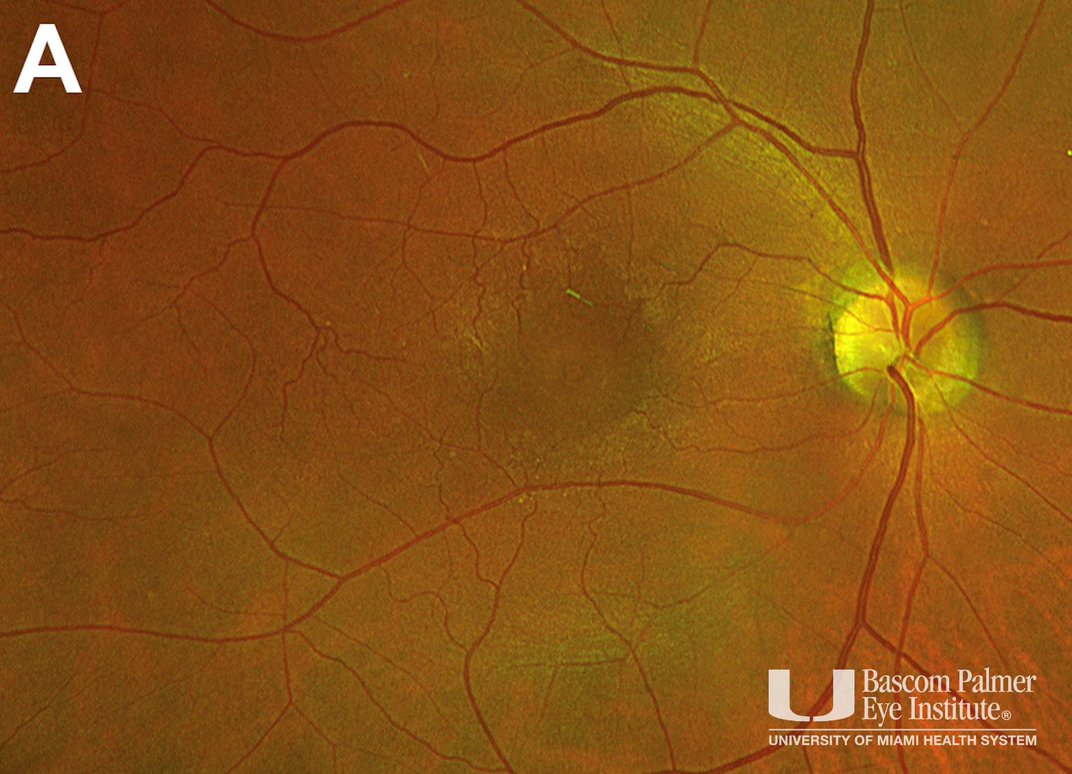 Macular Hole