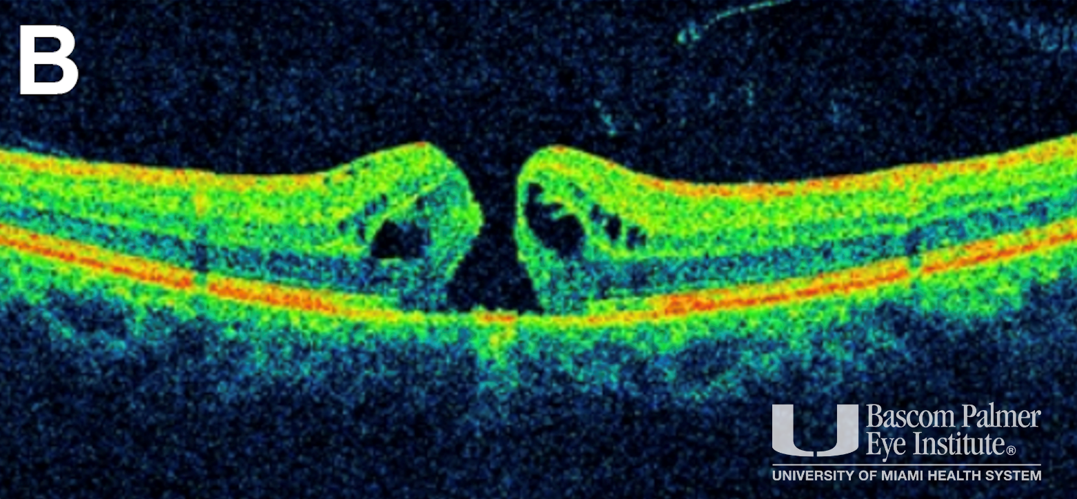 Macular Hole